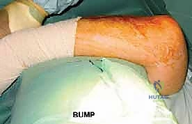 التصوير المقطعي الدقيق لكسور الكوع