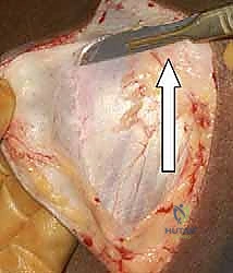 إزالة الشظايا العظمية المفتتة