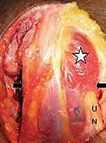 الشق الجراحي والوصول للمفصل