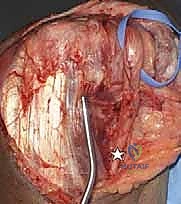 تجهيز الإسمنت العظمي الطبي