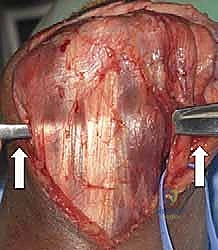 استخدام أدوات القياس الجراحية