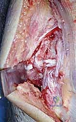 توسيع القناة العظمية للعضد