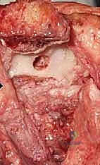 تحديد وحماية العصب الزندي