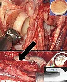 صورة توضيحية لـ استبدال مفصل الكوع الكلي لكسور عظم العضد المفتتة: دليل شامل للمرضى مع الأستاذ الدكتور محمد هطيف