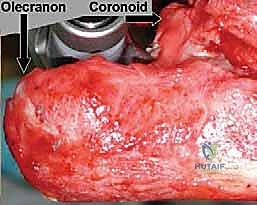 تثبيت جذع الزند بدقة