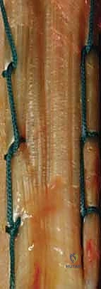 Intraoperative Surgical Step