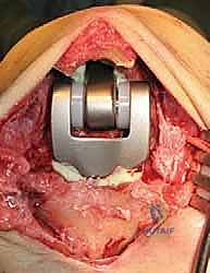 التأكد من استقامة المحور العظمي