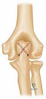 صورة توضيحية لـ استبدال مفصل الكوع الكلي لكسور عظم العضد المفتتة: دليل شامل للمرضى مع الأستاذ الدكتور محمد هطيف