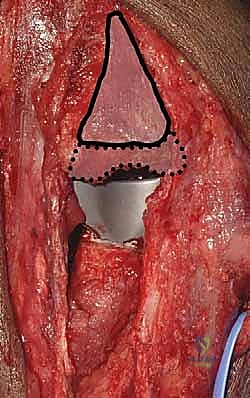 إعادة بناء الأوتار والأنسجة الرخوة