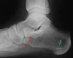 الفحص السريري لتشخيص القدم المسطحة المكتسبة