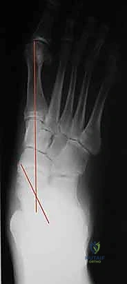 تطور مراحل القدم المسطحة وانهيار القوس