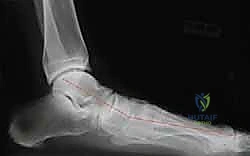 الأشعة السينية تظهر التشوه الثابت في المراحل المتقدمة