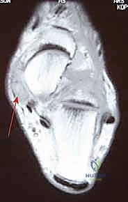 استخدام الدعامات والأحذية الطبية كعلاج تحفظي