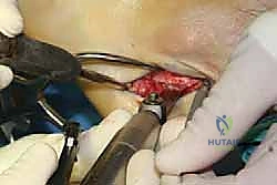 التشريح الدقيق لوتر الظنبوب الخلفي وعظام القدم