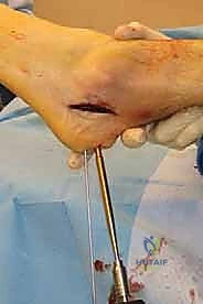 صور الأشعة السينية والرنين المغناطيسي لتشخيص القدم المسطحة