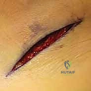 التخطيط الجراحي لعملية إعادة بناء القدم المسطحة