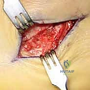 صورة توضيحية لـ جراحة القدم المسطحة المكتسبة لدى البالغين الحل الشامل لاستعادة القوس الطبيعي مع الأستاذ الدكتور محمد هطيف