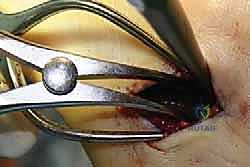 جراحة القدم المسطحة المكتسبة لدى البالغين الحل الشامل لاستعادة القوس الطبيعي مع الأستاذ الدكتور محمد هطيف