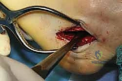 صورة توضيحية لـ جراحة القدم المسطحة المكتسبة لدى البالغين الحل الشامل لاستعادة القوس الطبيعي مع الأستاذ الدكتور محمد هطيف