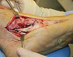 صورة توضيحية لـ جراحة القدم المسطحة المكتسبة لدى البالغين الحل الشامل لاستعادة القوس الطبيعي مع الأستاذ الدكتور محمد هطيف