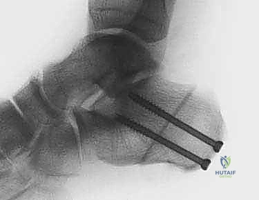 اختبار الوقوف على كعب واحد لتقييم قوة الوتر