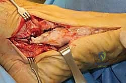 صورة توضيحية لـ جراحة القدم المسطحة المكتسبة لدى البالغين الحل الشامل لاستعادة القوس الطبيعي مع الأستاذ الدكتور محمد هطيف