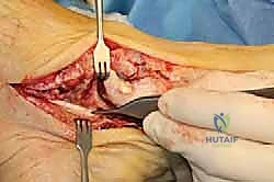 صورة توضيحية لـ جراحة القدم المسطحة المكتسبة لدى البالغين الحل الشامل لاستعادة القوس الطبيعي مع الأستاذ الدكتور محمد هطيف