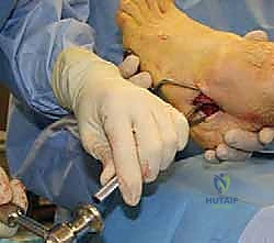 مراحل تدهور وتر الظنبوب الخلفي وضعف التروية الدموية