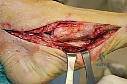 صورة توضيحية لـ جراحة القدم المسطحة المكتسبة لدى البالغين الحل الشامل لاستعادة القوس الطبيعي مع الأستاذ الدكتور محمد هطيف