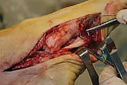 صورة توضيحية لـ جراحة القدم المسطحة المكتسبة لدى البالغين الحل الشامل لاستعادة القوس الطبيعي مع الأستاذ الدكتور محمد هطيف