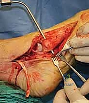 صورة طبية: جراحة القدم المسطحة المكتسبة لدى البالغين الحل الشامل لاستعادة القوس الطبيعي مع الأستاذ الدكتور محمد هطيف