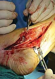 صورة طبية: جراحة القدم المسطحة المكتسبة لدى البالغين الحل الشامل لاستعادة القوس الطبيعي مع الأستاذ الدكتور محمد هطيف