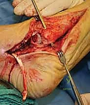 صورة توضيحية لـ جراحة القدم المسطحة المكتسبة لدى البالغين الحل الشامل لاستعادة القوس الطبيعي مع الأستاذ الدكتور محمد هطيف