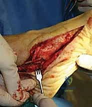 صورة توضيحية لـ جراحة القدم المسطحة المكتسبة لدى البالغين الحل الشامل لاستعادة القوس الطبيعي مع الأستاذ الدكتور محمد هطيف