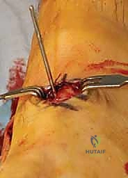 صورة طبية: جراحة القدم المسطحة المكتسبة لدى البالغين الحل الشامل لاستعادة القوس الطبيعي مع الأستاذ الدكتور محمد هطيف