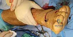 صورة طبية: جراحة القدم المسطحة المكتسبة لدى البالغين الحل الشامل لاستعادة القوس الطبيعي مع الأستاذ الدكتور محمد هطيف