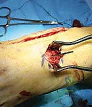 صورة طبية: جراحة القدم المسطحة المكتسبة لدى البالغين الحل الشامل لاستعادة القوس الطبيعي مع الأستاذ الدكتور محمد هطيف