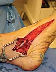 صورة طبية: جراحة القدم المسطحة المكتسبة لدى البالغين الحل الشامل لاستعادة القوس الطبيعي مع الأستاذ الدكتور محمد هطيف