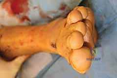 Adult Acquired Flatfoot Reconstruction: FDL Transfer & Medial Displacement Calcaneal Osteotomy Masterclass