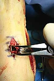 صورة طبية: جراحة القدم المسطحة المكتسبة لدى البالغين الحل الشامل لاستعادة القوس الطبيعي مع الأستاذ الدكتور محمد هطيف