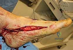 صورة طبية: جراحة القدم المسطحة المكتسبة لدى البالغين الحل الشامل لاستعادة القوس الطبيعي مع الأستاذ الدكتور محمد هطيف