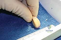 صورة طبية: جراحة القدم المسطحة المكتسبة لدى البالغين الحل الشامل لاستعادة القوس الطبيعي مع الأستاذ الدكتور محمد هطيف