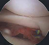 صورة توضيحية لـ إعادة بناء الزاوية الخلفية الوحشية للركبة: دليل شامل للمرضى مع الأستاذ الدكتور محمد هطيف