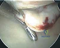 صورة توضيحية لـ إعادة بناء الزاوية الخلفية الوحشية للركبة: دليل شامل للمرضى مع الأستاذ الدكتور محمد هطيف