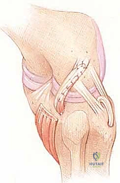 الأعراض السريرية ومشية اندفاع التقوس