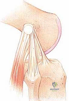 آليات الإصابة والحوادث المؤدية للتمزق