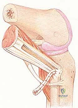 صورة توضيحية لـ إعادة بناء الزاوية الخلفية الوحشية للركبة: دليل شامل للمرضى مع الأستاذ الدكتور محمد هطيف