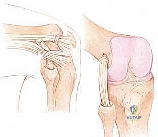 صورة توضيحية لـ إعادة بناء الزاوية الخلفية الوحشية للركبة: دليل شامل للمرضى مع الأستاذ الدكتور محمد هطيف