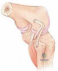 إعادة بناء الزاوية الخلفية الوحشية للركبة: دليل شامل للمرضى مع الأستاذ الدكتور محمد هطيف