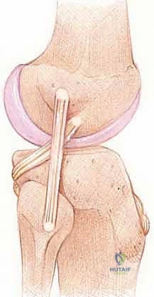 صورة توضيحية لـ إعادة بناء الزاوية الخلفية الوحشية للركبة: دليل شامل للمرضى مع الأستاذ الدكتور محمد هطيف